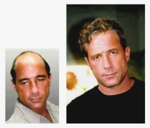 Men's Hair Replacement Systems Before And After - Hair Transplantation