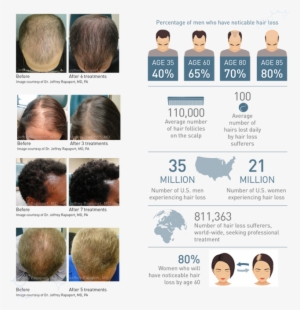 However, There Is Evidence That Regular Treatments - Prp Hair Restoration Rapaport