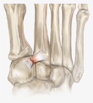 The Lisfranc Ligament Is A Strong Ligament In The Midfoot - Lesão De Turco Pé