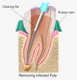 Root Canal Transparent - Artificial Nerves Root Canal