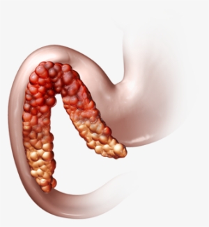 The Pancreas, While Being A Small Organ, Delivers A - Annular Pancreas