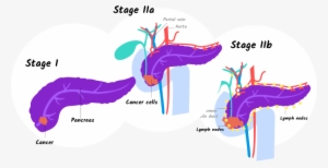 Illustration Of Stage I And Stage Iia And Iib Pancreatic - Stage 1 Stage 2 Pancreatic Cancer