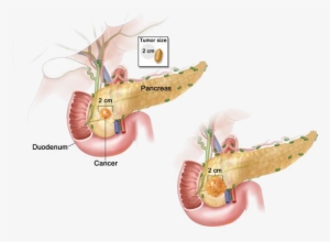 Periampullary Neoplasms - Stage 1 Pancreatic Cancer
