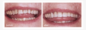 Shot Of Before And After Visiting Abington Smile Gallery - Lip
