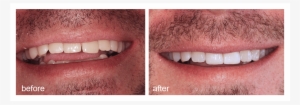 Shot Of Before And After Visiting Abington Smile Gallery - Dentist
