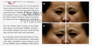A 50 Year Old Woman Before The Treatment (c,d) And - Close-up