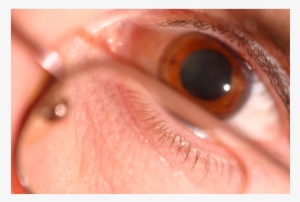 Eyes Pupil Dilation - Mydriasis