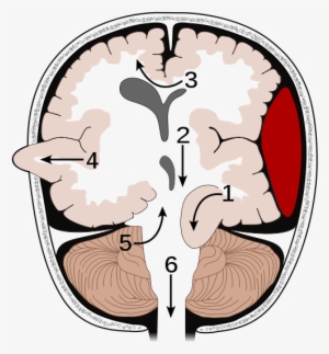 Brain Herniation Types - Types Of Brain Herniation