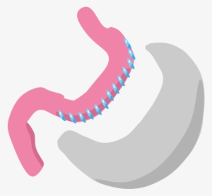 Fig 1 In A Sleeve Gastrectomy, The Greater Curvature - Gastrectomia Vertical