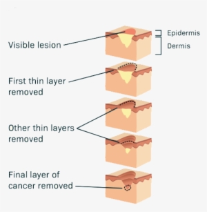 Mohs-surgery - Skin Cancer