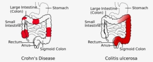 Crohn's Disease Vs Colitis Ulcerosa - Difference Between Crohns And Ulcerative Colitis
