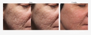 Before And Afters - Bellafill For Acne Scars