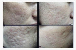 Patient With Rolling Acne Scar Before And Six Months - Freckle