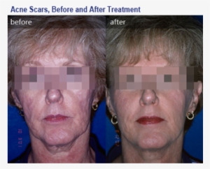 Photo Of Before & After Acne Scaring - Deep Rolling Acne Scars Chin