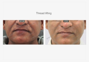 Face Lifting - Rhytidectomy