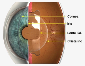 Phakic Iol Transparent PNG - 667x500 - Free Download on NicePNG