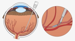 At The Moment, Treatment Consists Of Monthly Injections - Robot Assist For Retinal Vein Cannulation