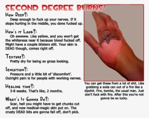Later On It Still Has A Sort Of Tougher Texture, And - Second Degree Burn Chart