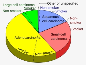Types Non Small Cell Lung Cancer - Most Common Lung Cancer