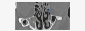 Uncinate Process Adheres With Middle Concha In Left - Ethmoidal Infundibulum