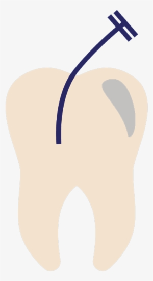 Endodontist Jacksonville Fl - Endodontics