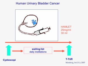 Human Urinary Bladder Cancer Treatment With Hamlet - Human