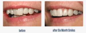 Clear Bracket Braces Before And After