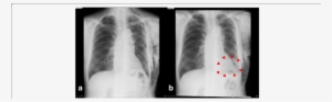 A Chest X-ray On Pod7 Reveals No Dead Space In The - Lung