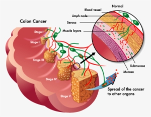 Approximately 150,000 New Cases Of Colorectal Cancer - Colon Cancer Stages