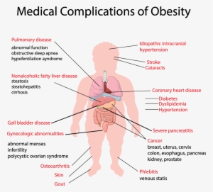 Medical Complications Obesity - Medical Obesity Complication