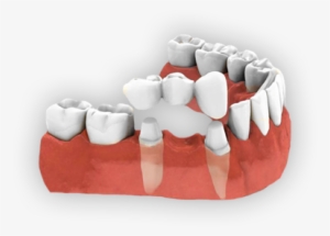 Crowns And Bridges - Dental Bridge Png
