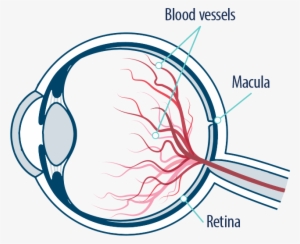Eye Blood Vessels, Macula, And Retina - Retinal Vein Occlusion Cartoon
