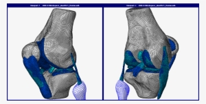 Human Knee Joint Fe Model - Human Knee Finite Element Method