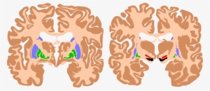 Spastic Cerebral Palsy Brain
