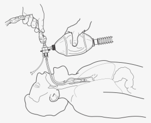This Free Icons Png Design Of Endotracheal Procedure
