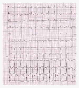 Ecg Showing Sinus Tachycardia And Ischemic Changes