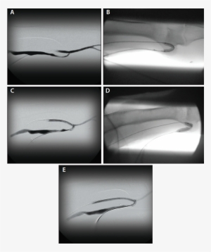 Figure 2 - - Fistula