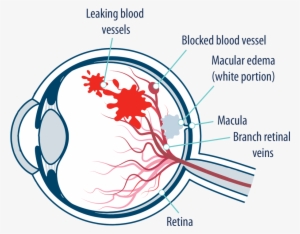 Eye With Macular Edema Following Retinal Vein Occlusion - Macula Of Retina