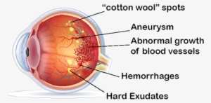 Diabetic Retinopathy - Cataract
