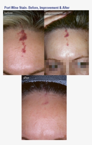 Before & After Photos - Pulsed Dye Laser Red Scar
