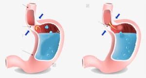 Gasteroesophageal Reflux Disease - Gerd Symptoms