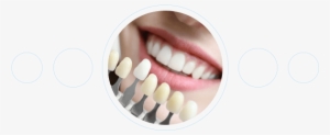 Veneers - Veneer