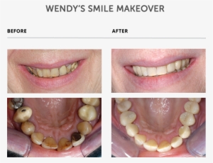 Weybridge Teeth Smile Makeover - Teeth Makeover
