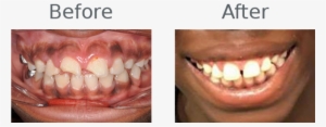 Luckily, This Student's Mouth Was In Good Shape, And - Cosmetic Dentistry