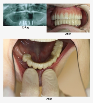 Implants Permanent Teeth Smile Gallery - Do Adult Teeth Look Like