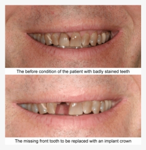 Before And After Case Examples All Of These Cases Shown - Tongue