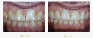 Smile Gallery Before After - Smile Gallery