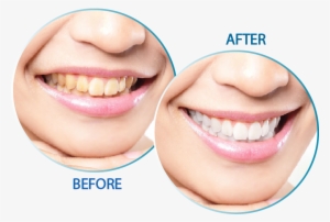 Teeth Whitening - Peridex Stain