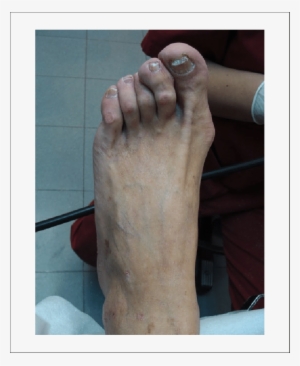 This Bone Prominence Is Highly Associated With Ulcers - Hammer Toe