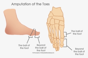 The Amputation Of The Toes 6 - Hallux Amputation